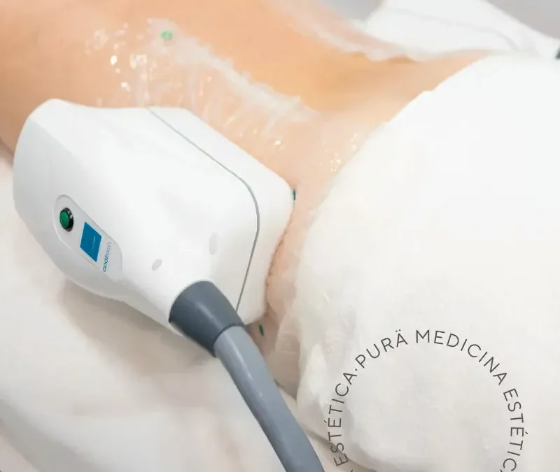 CoolSculpting: La Revolución en la Reducción de Grasa en Málaga y Nerja