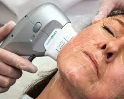 Ultraformer III: la tecnología que está iluminando la nueva era del rejuvenecimiento facial y corporal